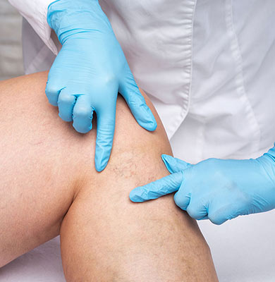 Venous Ulcers
